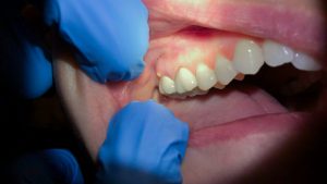 how do you get an abscess tooth