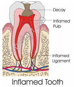 inflammedtooth