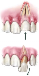 apicoectomy teeth