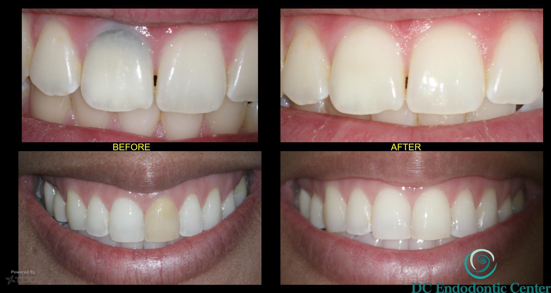 Intracoronal Bleaching DC Endodontic Center