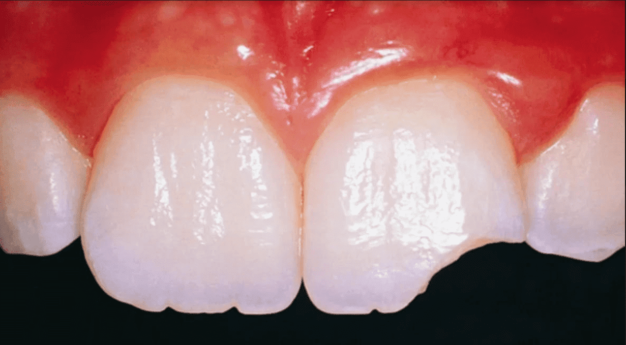 Simplexity in dental trauma - Styleitalianoorg