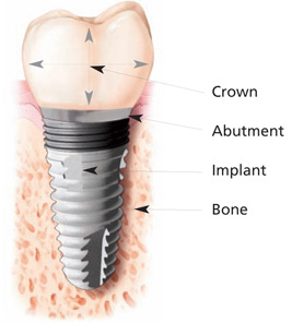 Implant2