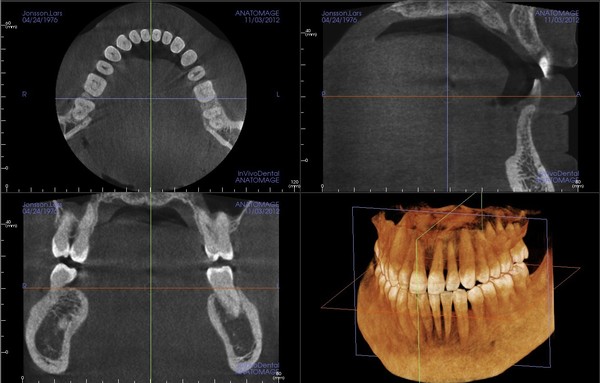 CBCT Cone Beam Computed Tomography