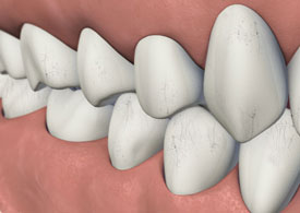 Jonathan S Dean DDS - What are craze lines? Craze lines are minute vertical  lines that form on the teeth. Cracked teeth and craze lines are often  confused for each other; however