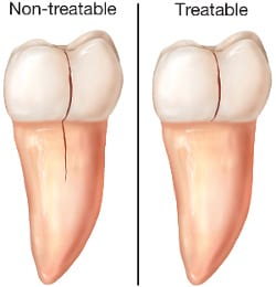Cracked Teeth - St. Albert Endodontics