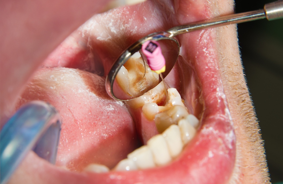 Root canal procedure on patient